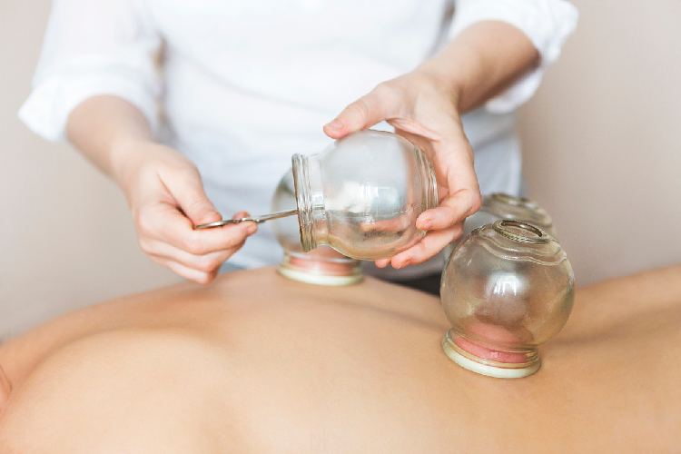 Boulder Japanese Acupuncture Cupping