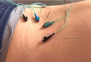 Frequency Specific Microcurrent Acupuncture